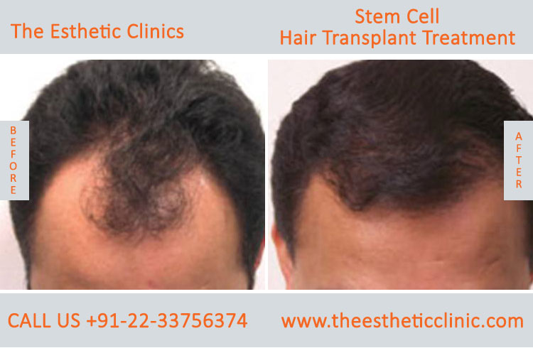 Stem Cell Hair Transplant Treatment before after photos in mumbai india (4)